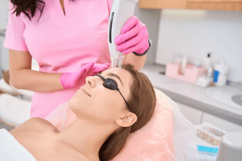 Vbeam Laser Toronto