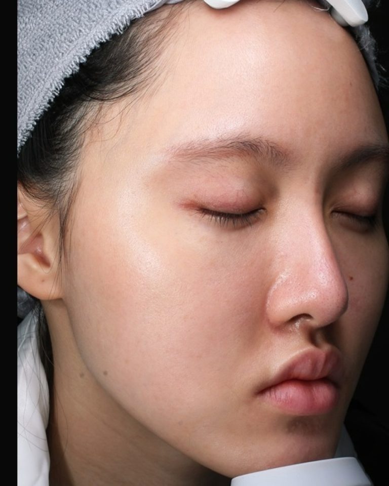 Acne · AI BBL HEROIC™ Acne Clearance + Vbeam® Redness Reduction · pimples and red marks eased in three-quarter view · after treatment
