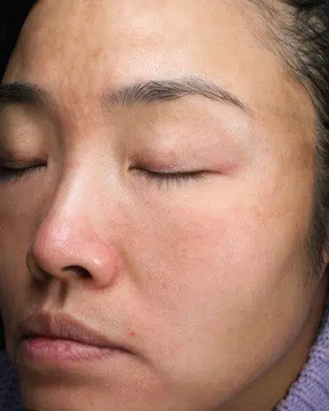 Pigmentation — After Treatment · Case 22 · ID Cosmetic