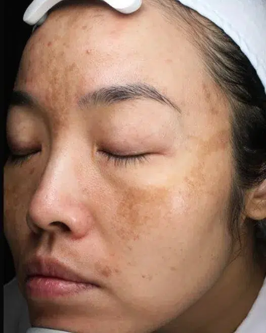Pigmentation — Before Treatment · Case 22 · ID Cosmetic