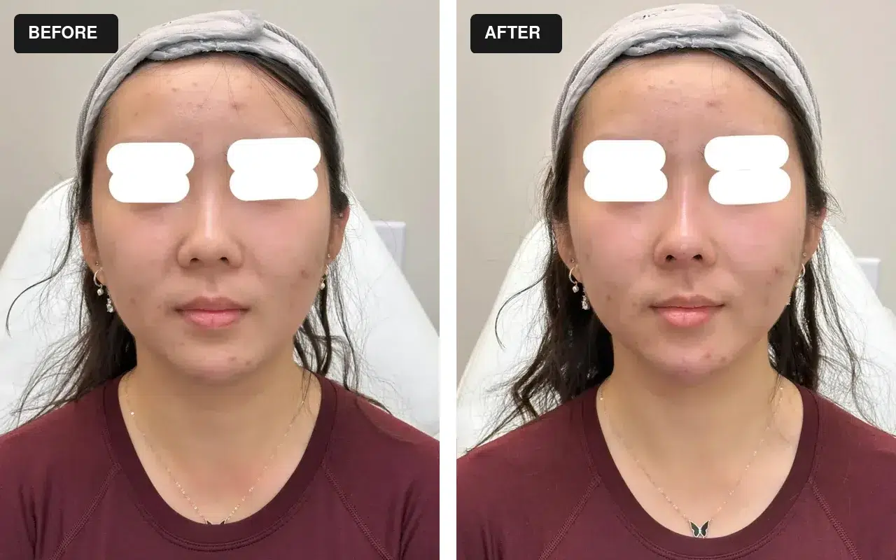 Enhance Your Look: A Complete Guide to Non-Surgical Nose Fillers