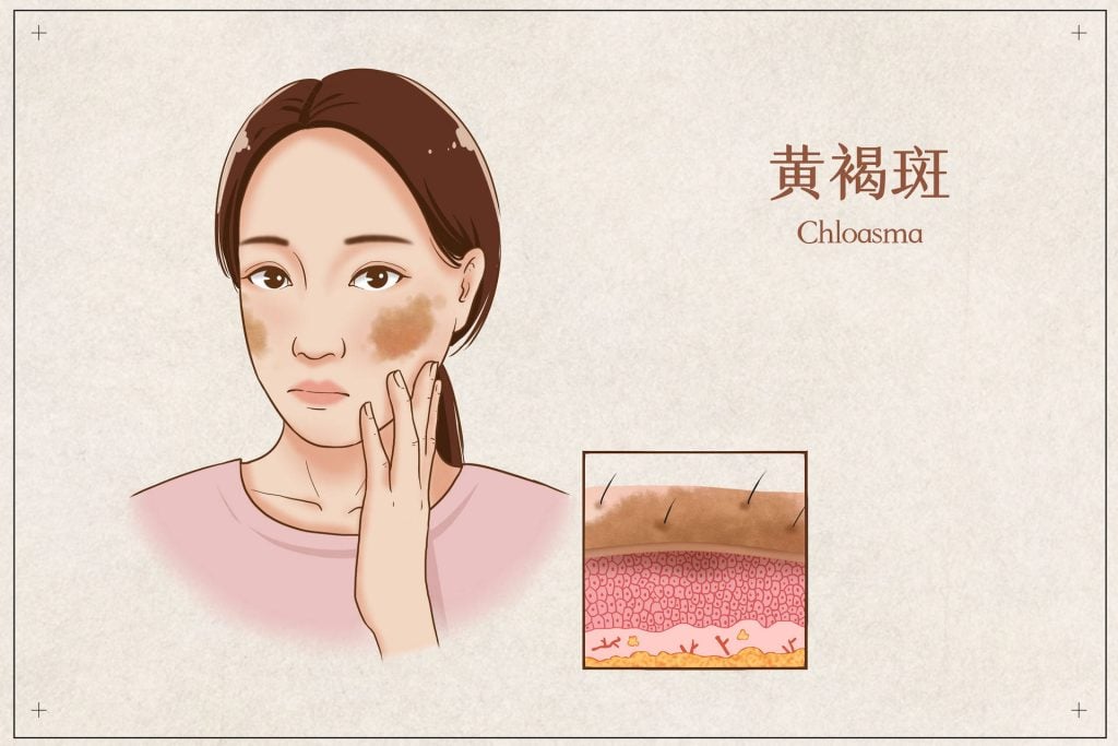 黄褐斑 多伦多 治疗 超皮秒