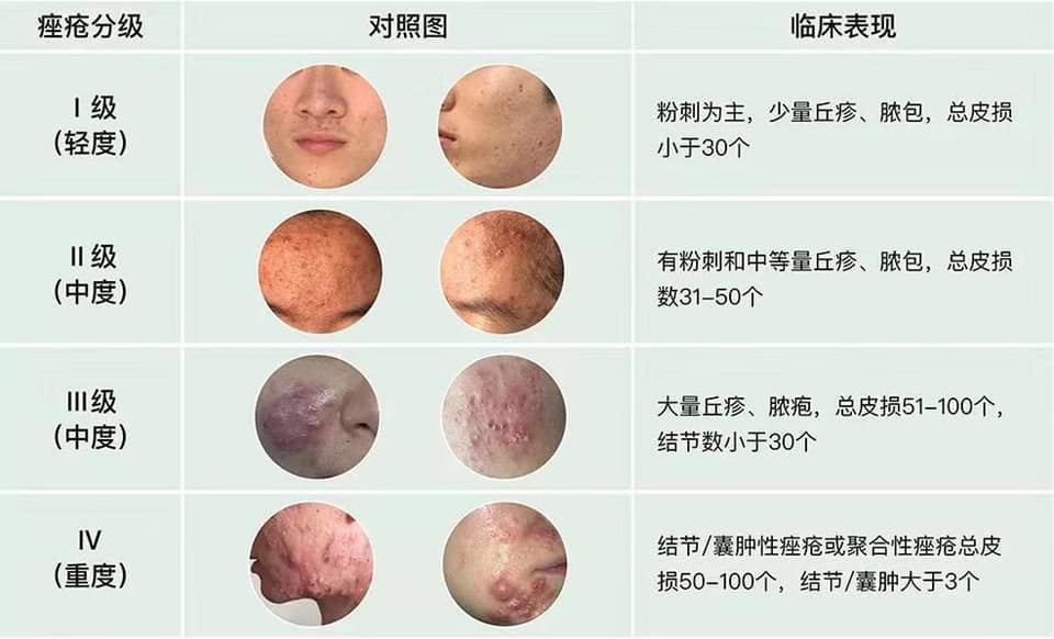 青春痘 如何治疗? 1 祛除 青春痘 痤疮 多伦多