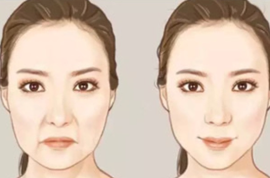 玻尿酸 填充法令纹