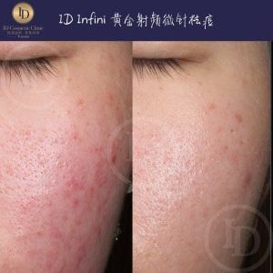 inifini 黄金微针 多伦多