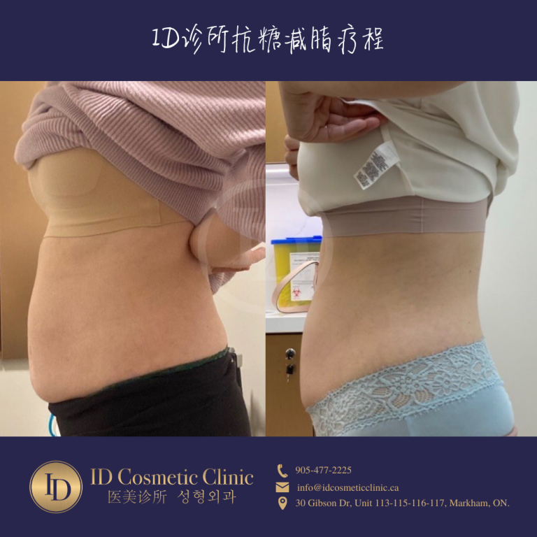 暴瘦30磅!马斯克钦点减肥针 - Ozempic® (司美格鲁肽)注射到底是何方神圣? 3 减肥针 多伦多 Weight Loss Toronto