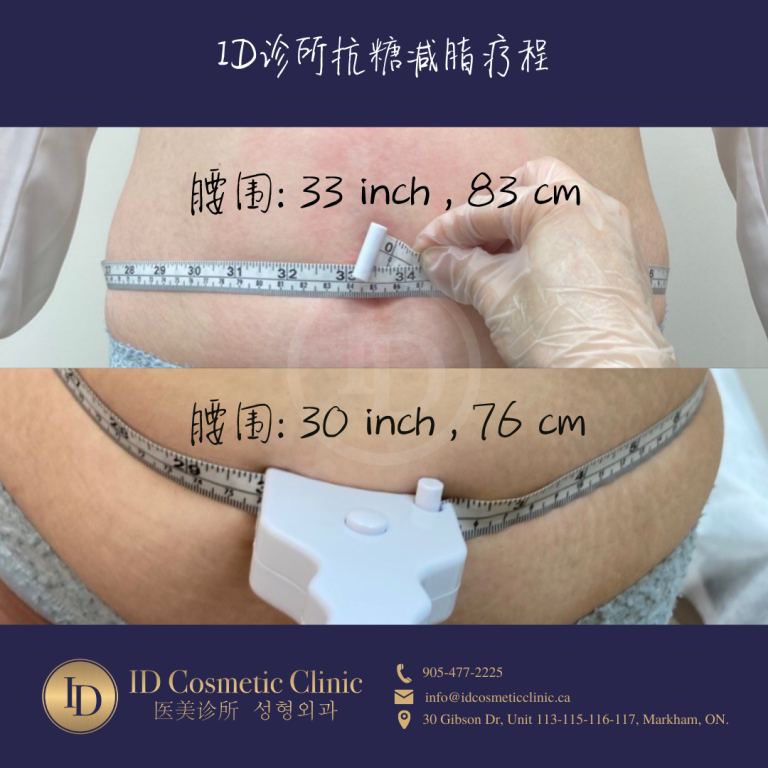 暴瘦30磅!马斯克钦点减肥针 - Ozempic® (司美格鲁肽)注射到底是何方神圣? 4 减肥针 多伦多 Weight Loss injection Toronto