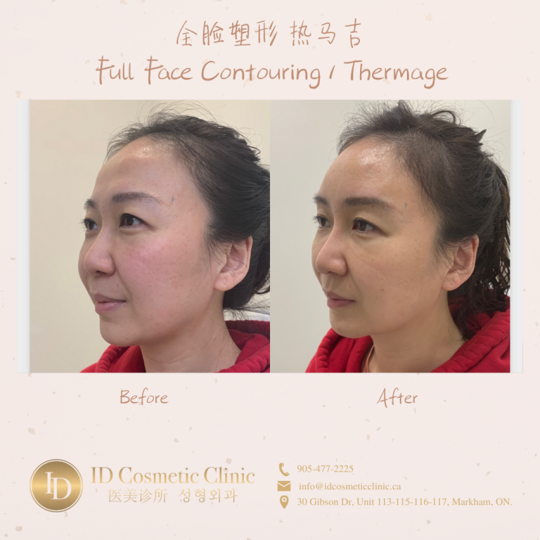 热玛吉 热玛吉疗程 多伦多