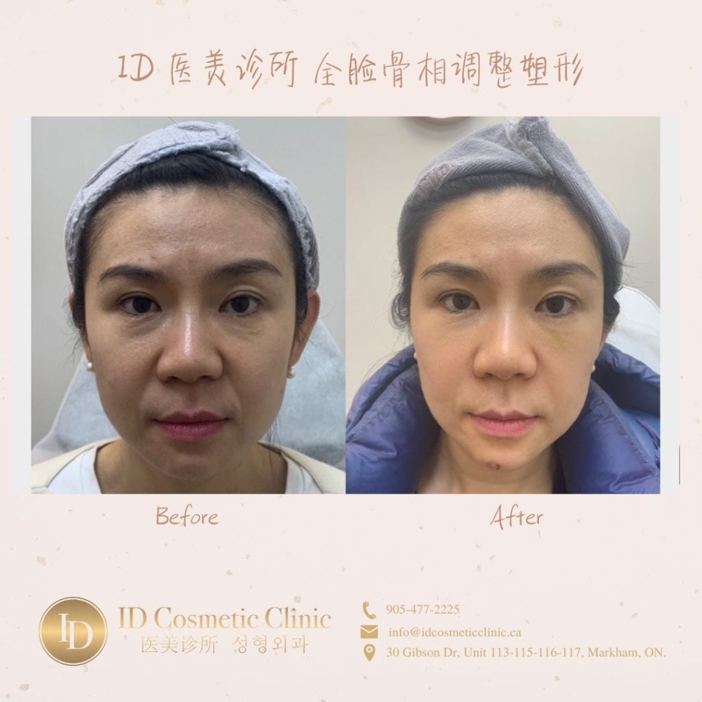 ID医美徐医生心得:如何避免变美路上的坑 2 骨相塑型 多伦多