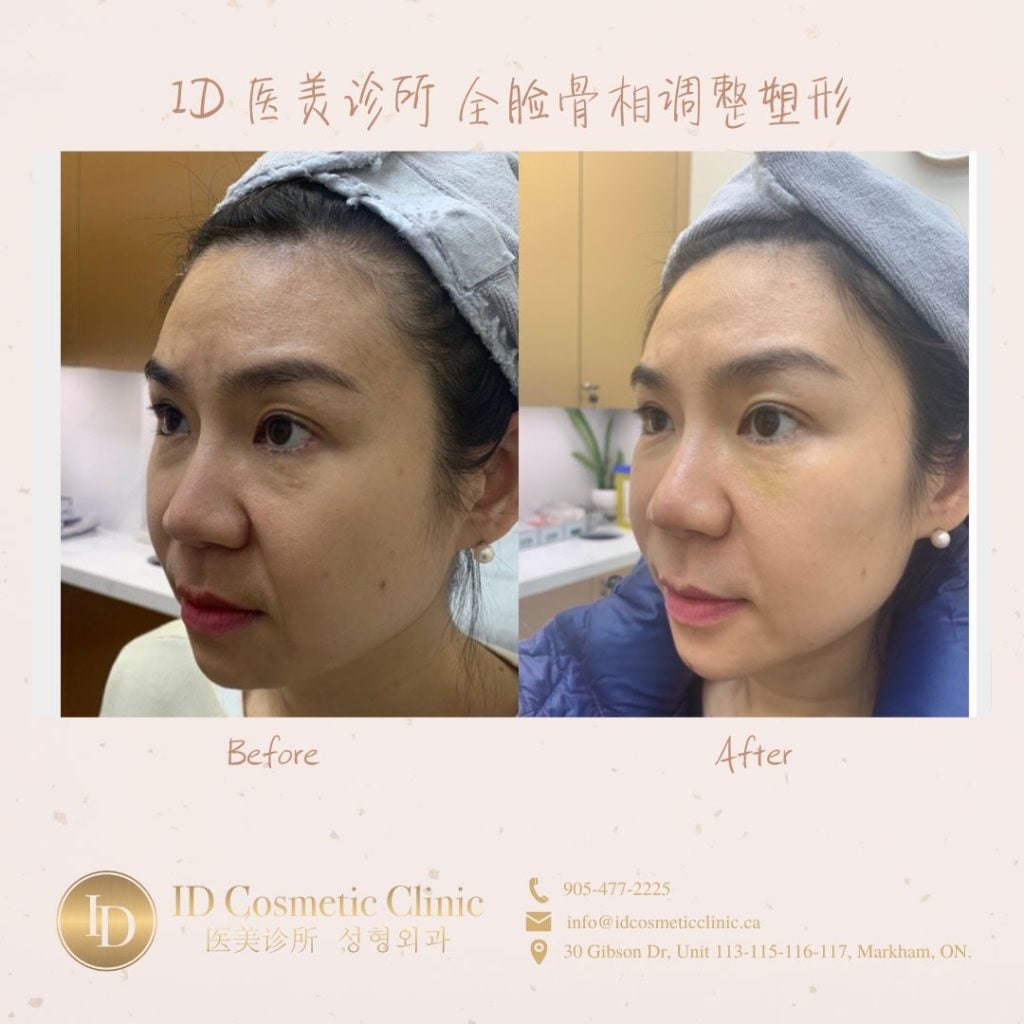 ID医美徐医生心得:如何避免变美路上的坑 3 骨相塑型 多伦多