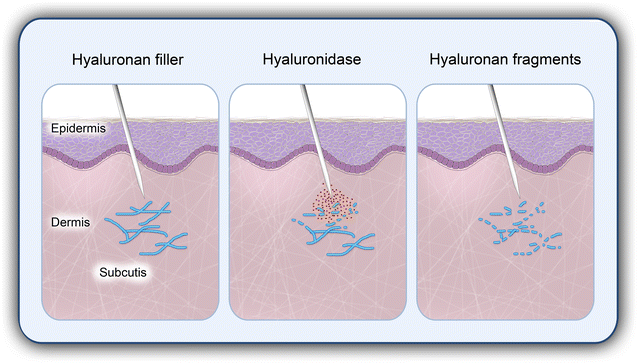 玻尿酸溶解酶 多伦多