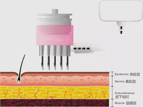 水光原理 多伦多 水光针