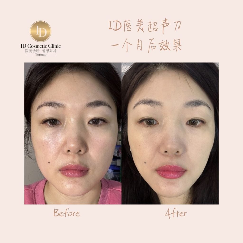 超声刀 超声炮 多伦多