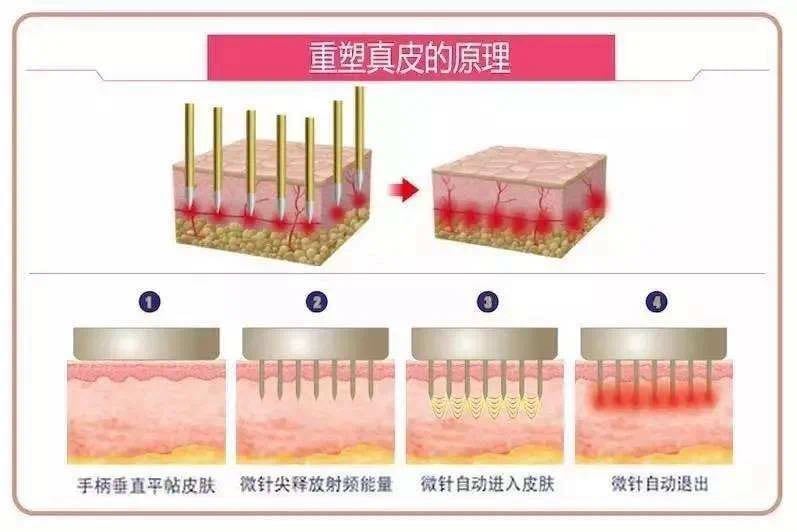 去痘坑,选黄金微针还是点阵激光? 1 黄金微针 多伦多 点阵激光 去痘坑