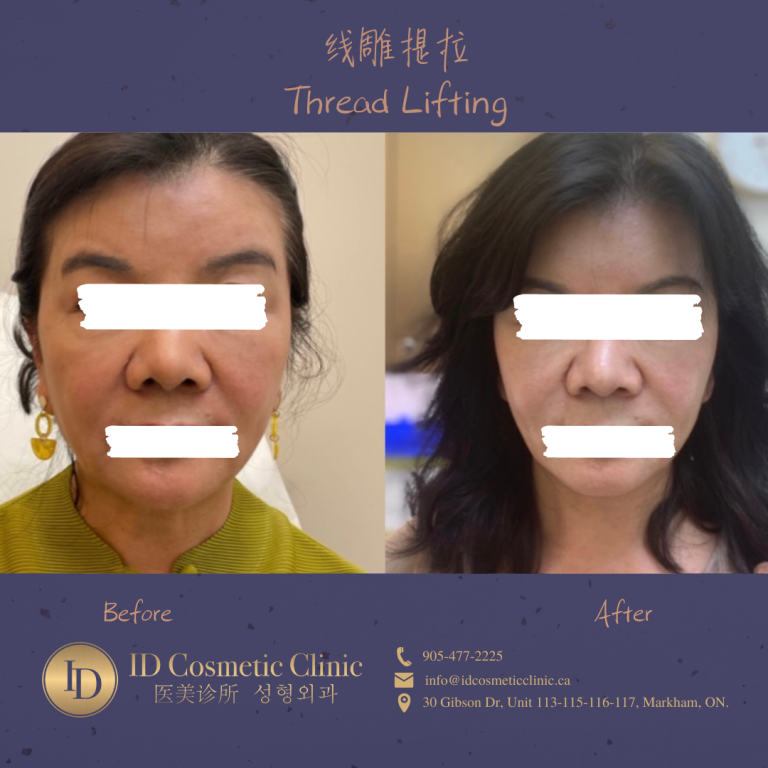 线雕 提拉 多伦多