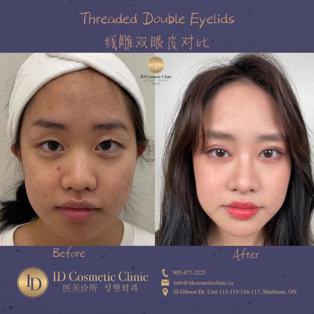 一站式解锁埋线双眼皮手术:迈向自然美丽之路 1 Double Eyelid Surgery 埋线双眼皮