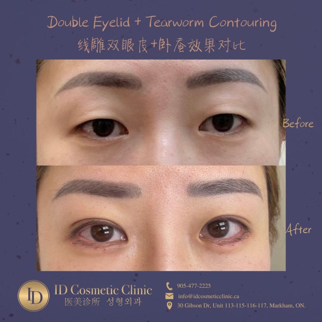 一站式解锁埋线双眼皮手术:迈向自然美丽之路 2 Double Eyelid Surgery 埋线双眼皮