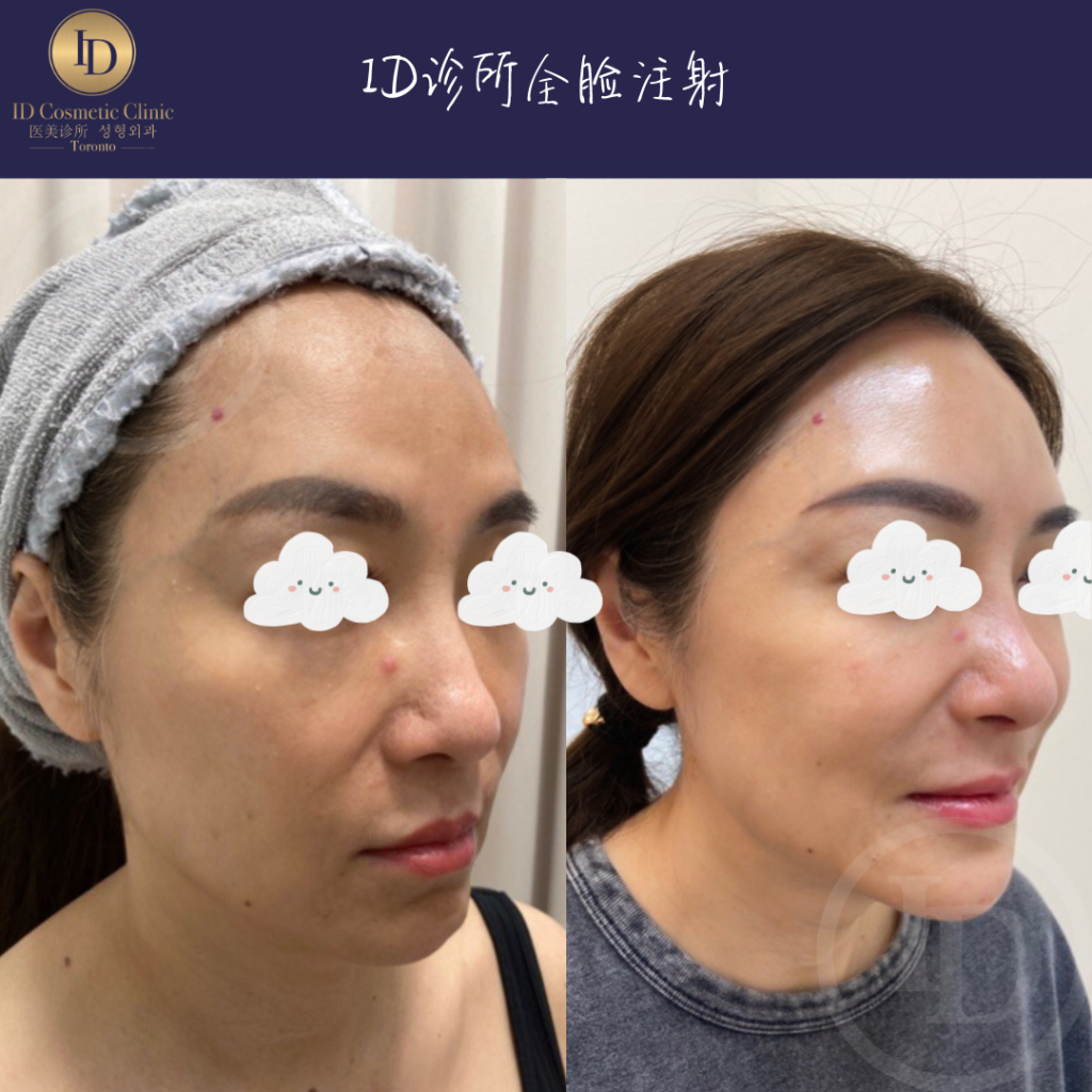 玻尿酸填充塑形,品牌差异一文搞懂 3 Erin Yang