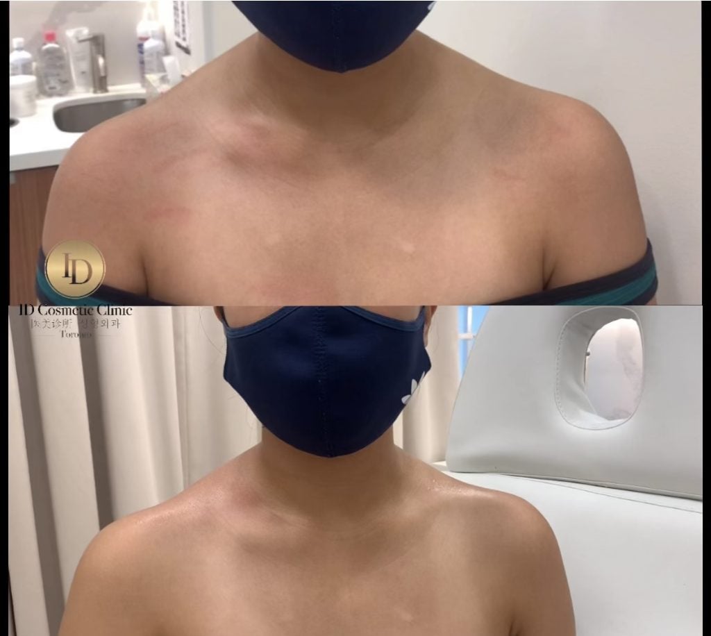 瘦肩针 多伦多 肉毒瘦肩