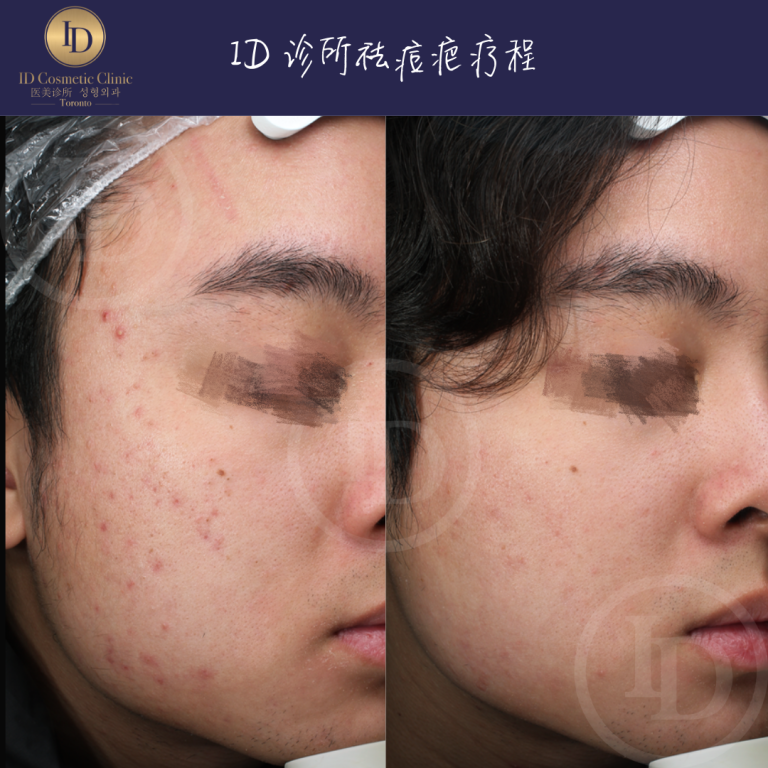 青春痘 如何治疗? 2 IMG 0329 2