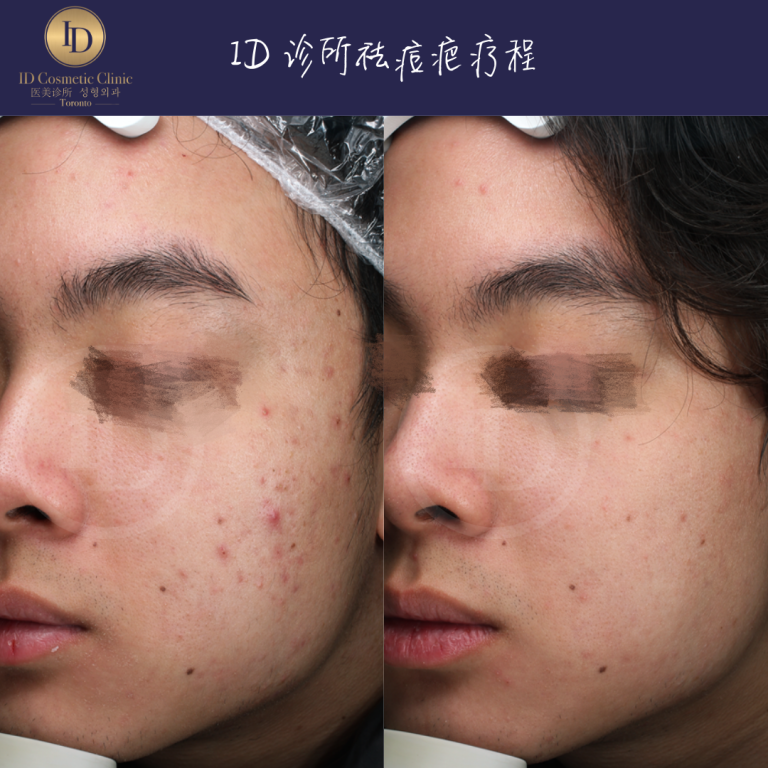 青春痘 如何治疗? 4 IMG 0330 5