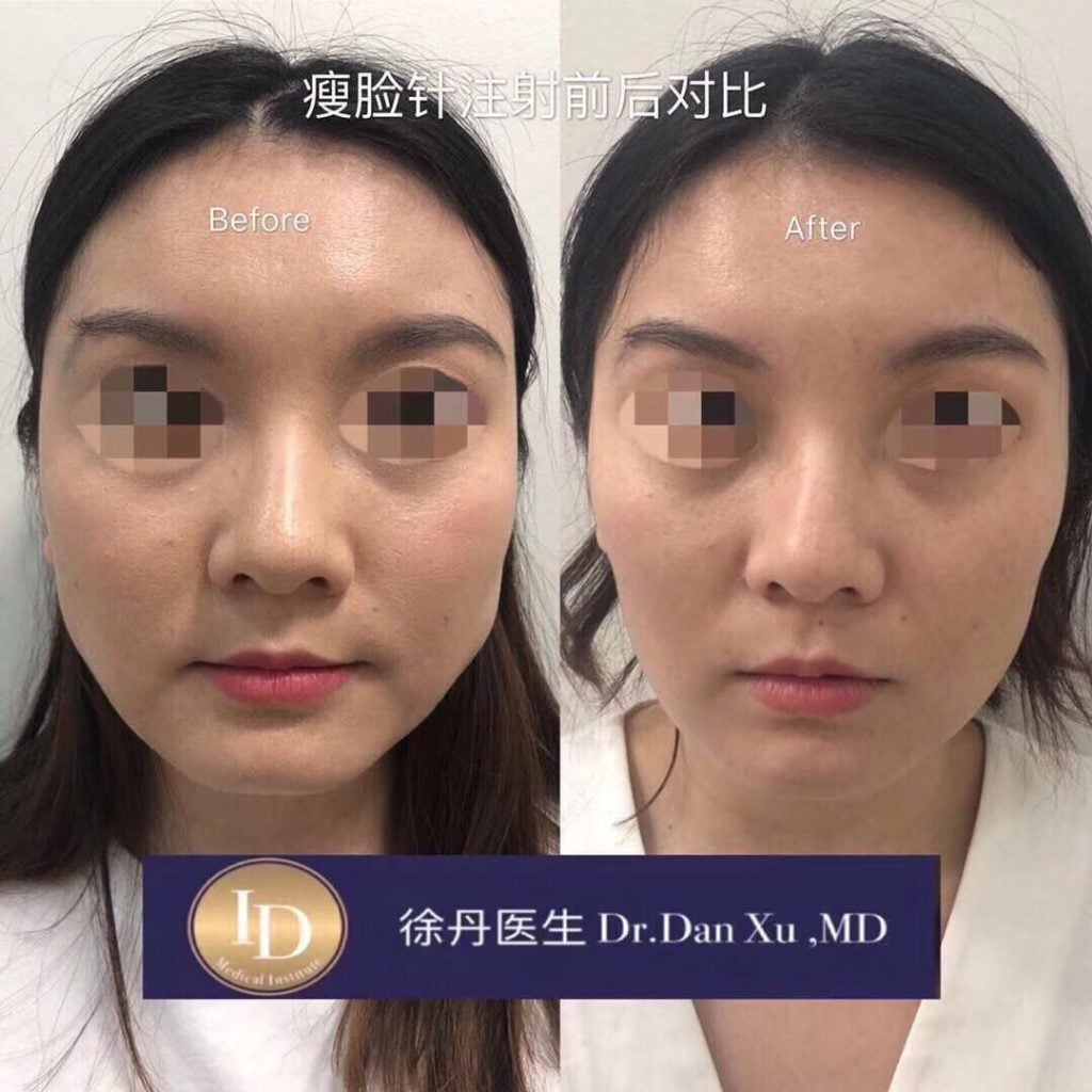 肉毒素 botox 淡化细纹 多伦多
