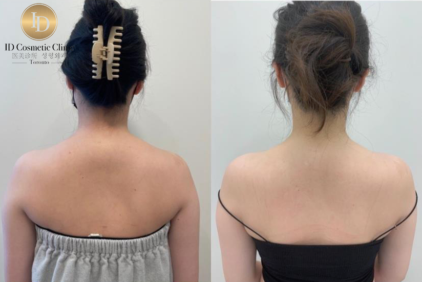 瘦肩针 多伦多 肉毒瘦肩