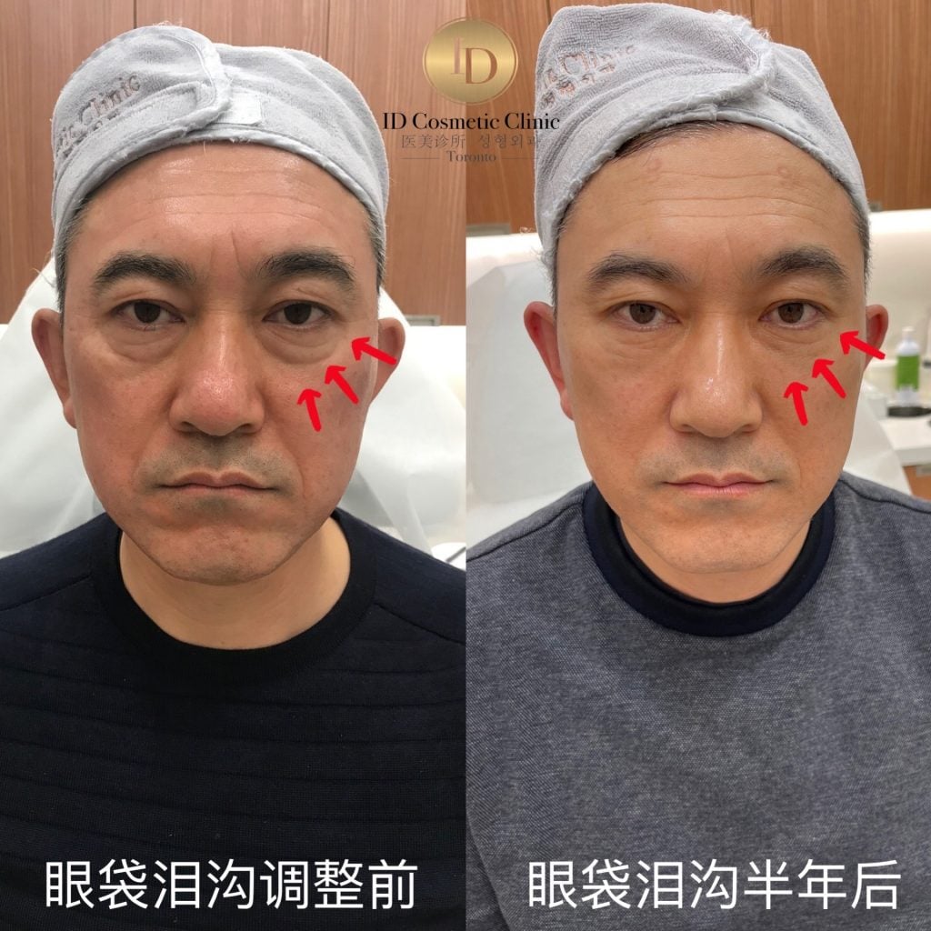 眼袋 消除 1 眼袋 去除