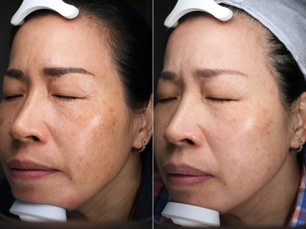 一文了解黄褐斑以及治疗方法 | 多伦多医美诊所 | ID医美 5 黄褐斑 治疗 多伦多