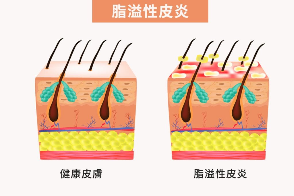 脂溢性皮炎 英文 多伦多 治疗