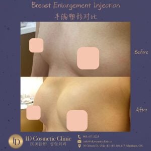 隆胸 多伦多