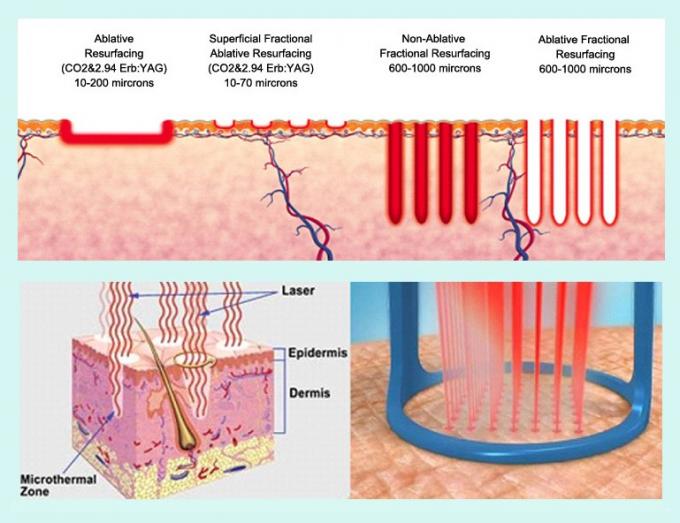ablative and nonablative fractional laser diagrams