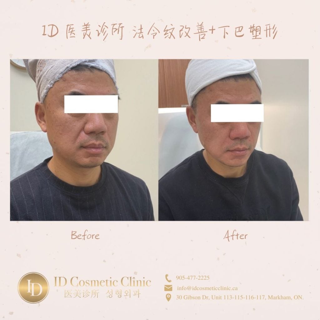 玻尿酸填充法令纹打在哪里? 1 玻尿酸填充 法令纹 多伦多