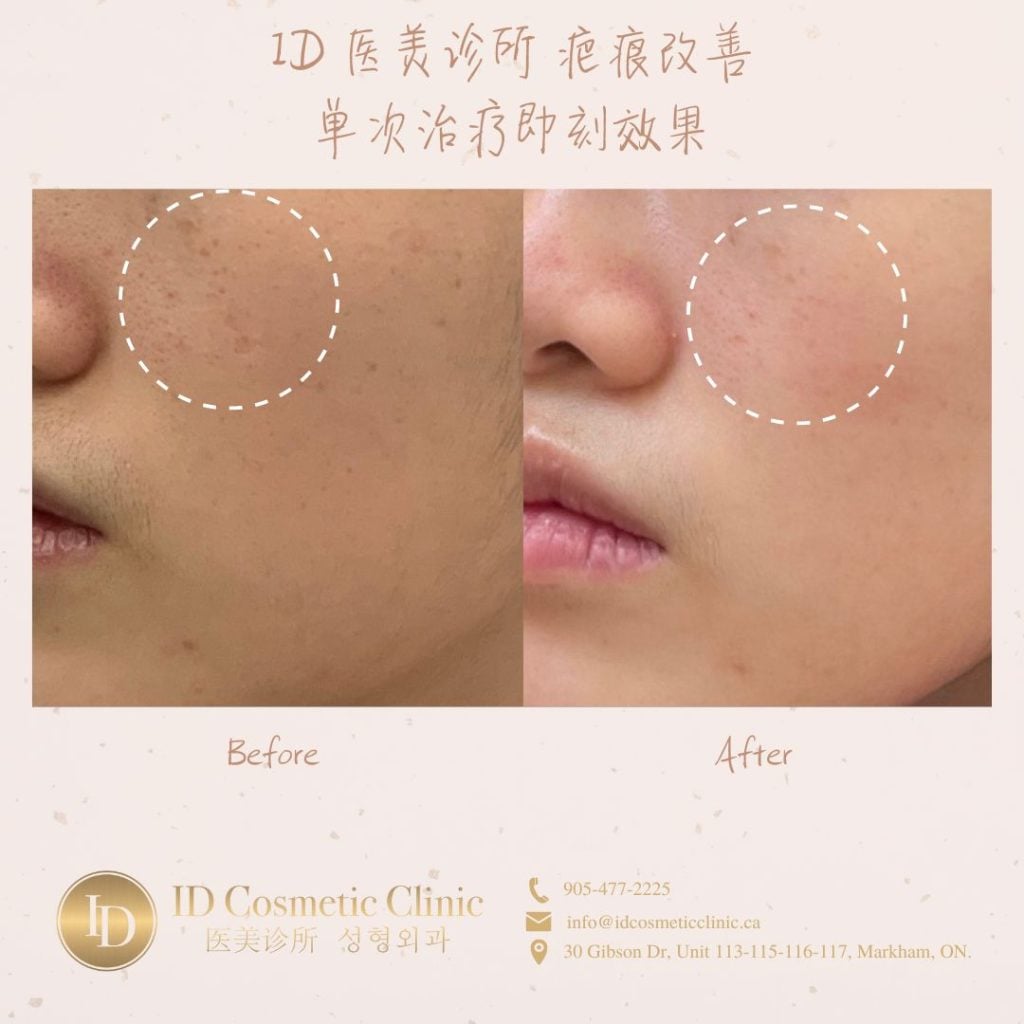 点阵激光 离我近的 祛痘 多伦多