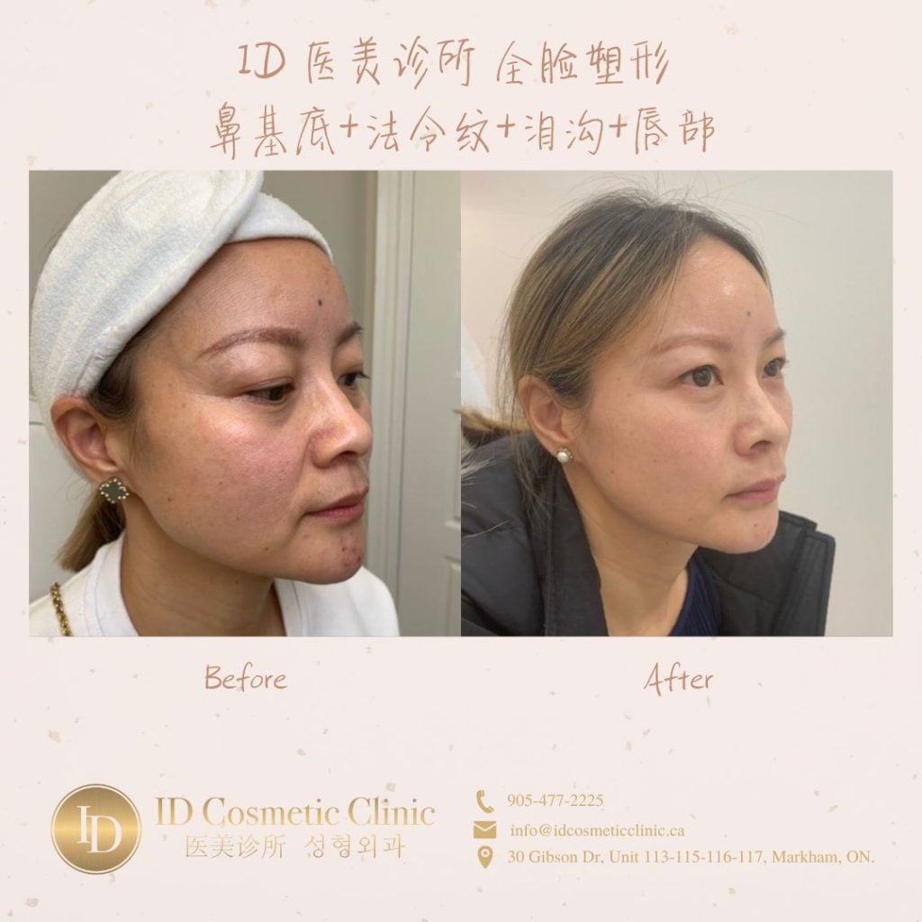 玻尿酸里的爱马仕——乔雅登(Juvéderm ) 为何是冻龄抗衰神器? 26 c 5