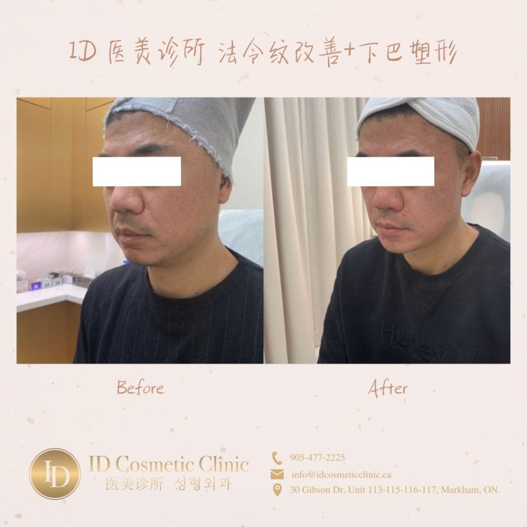 丝丽玻尿酸 多伦多 stylage