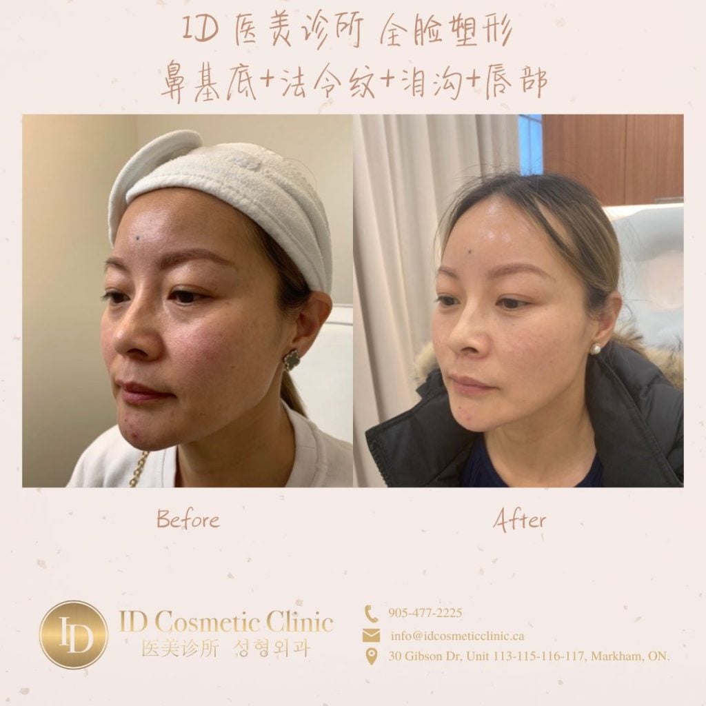 玻尿酸里的爱马仕——乔雅登(Juvéderm ) 为何是冻龄抗衰神器? 24 c 7 1