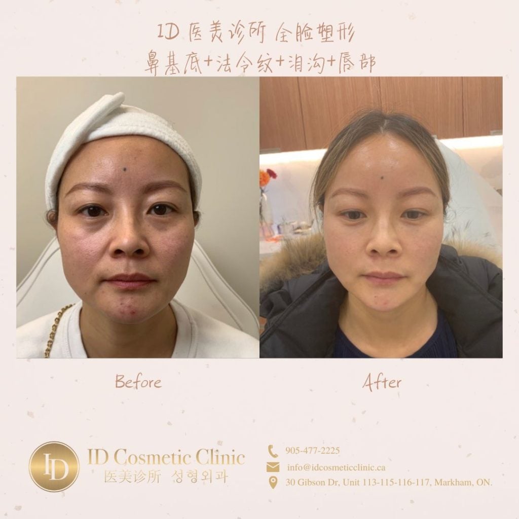 玻尿酸里的爱马仕——乔雅登(Juvéderm ) 为何是冻龄抗衰神器? 25 c 9