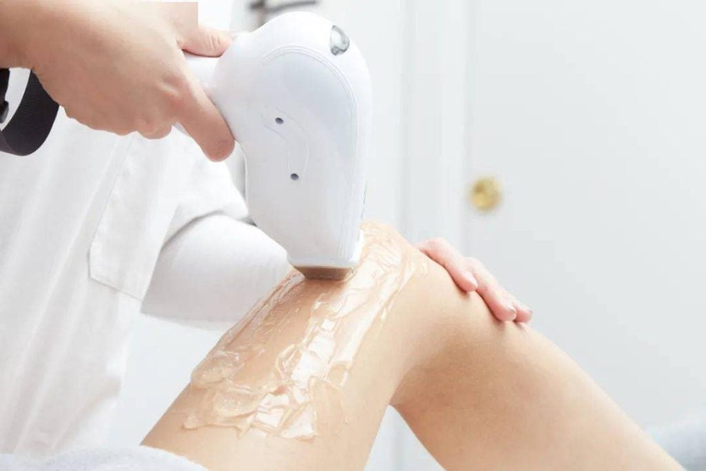 激光脱毛:全面指南 1 激光脱毛