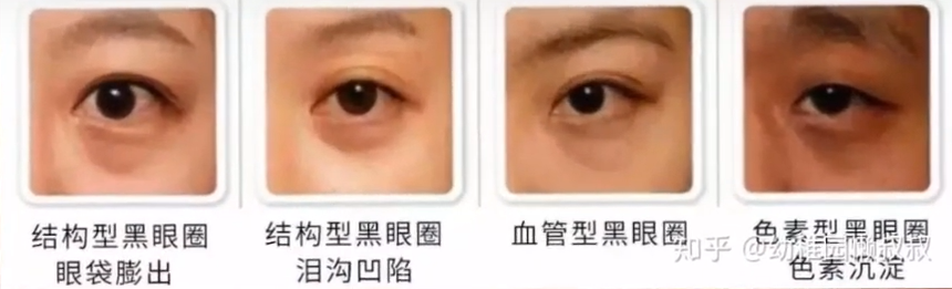 黑眼圈 治疗 多伦多