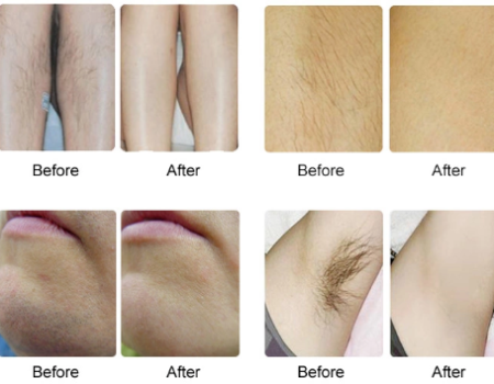 冰点脱毛:彻底摆脱多余毛发的终极指南 3 冰点脱毛