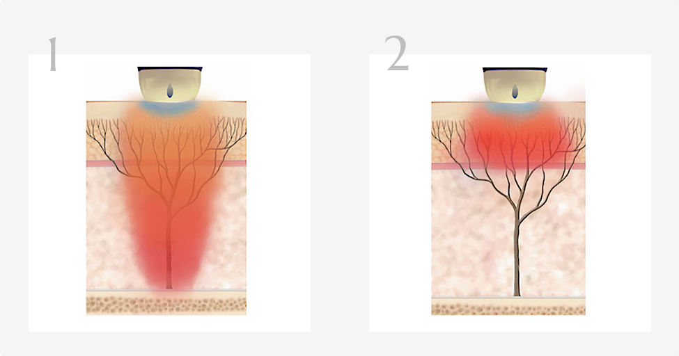 钛提升 Titanium Lifting:无创美容新选择 2 titanium 01 2