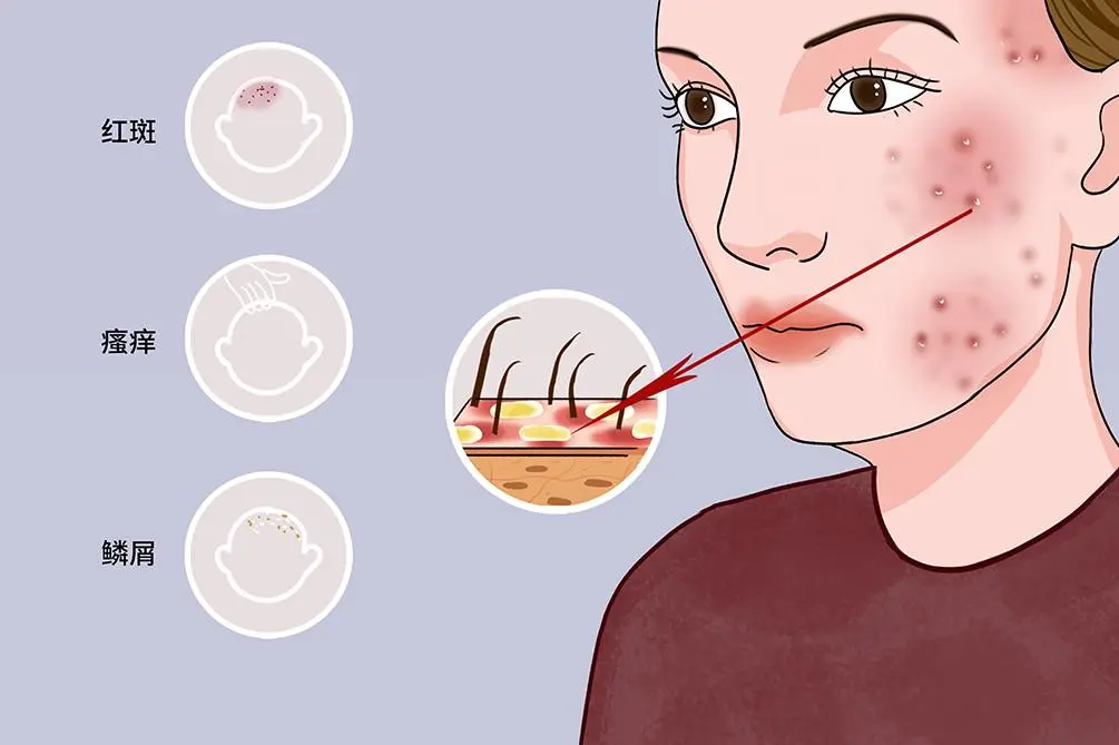 脂溢性皮炎:全面指南及治疗方法 1 脂溢性皮炎