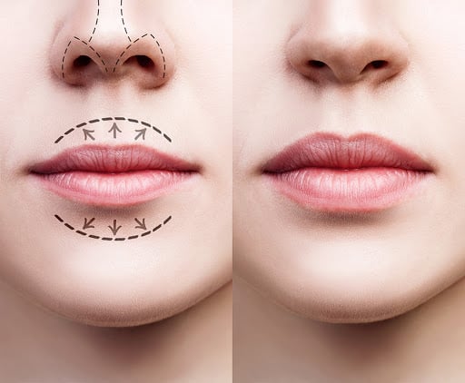 Lip Fillers 玻尿酸丰唇