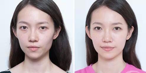 自体脂肪填充 多伦多