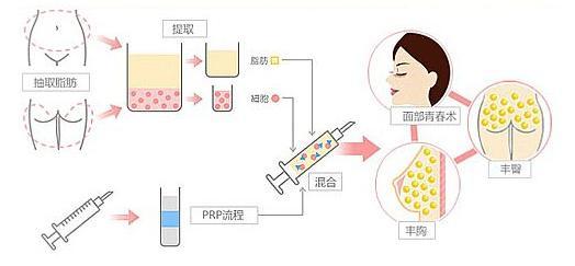 多伦多 自体脂肪