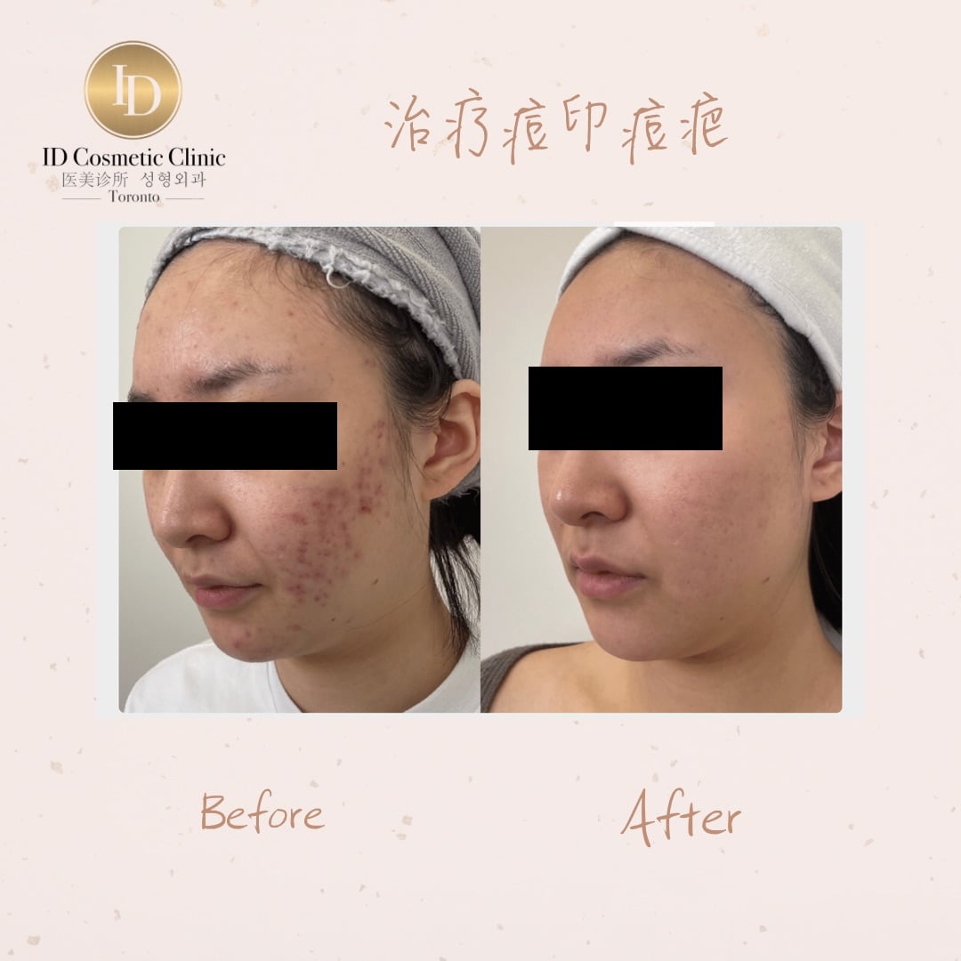 11.治疗痘疤痘印Consent 2