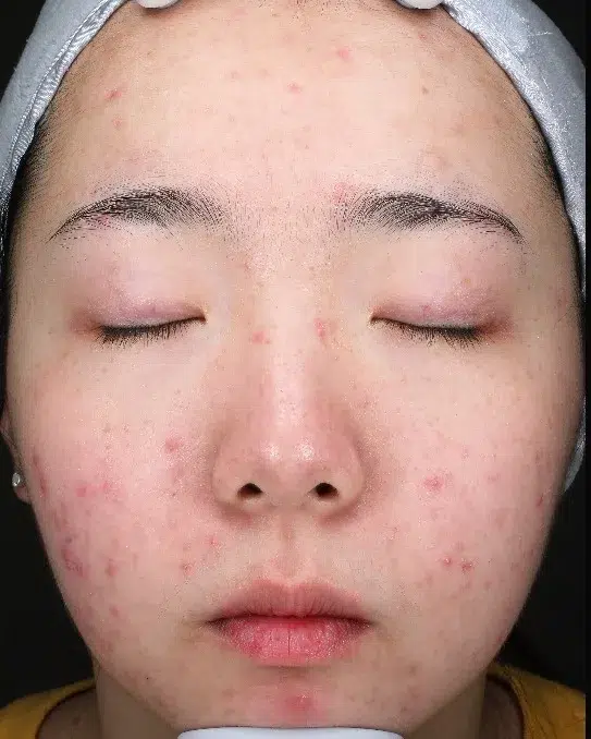 痘疤 治疗前 · 案例 03 · ID 医美