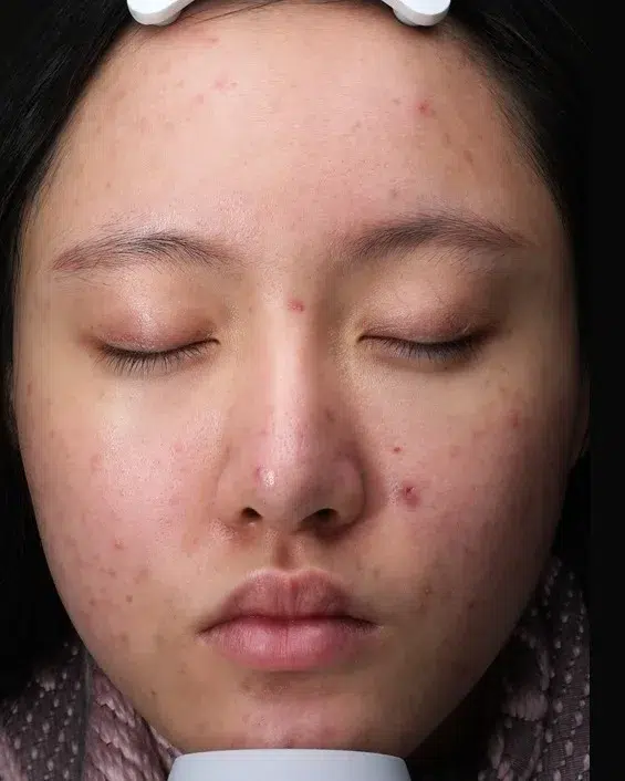 痘疤 治疗前 · 案例 05 · ID 医美