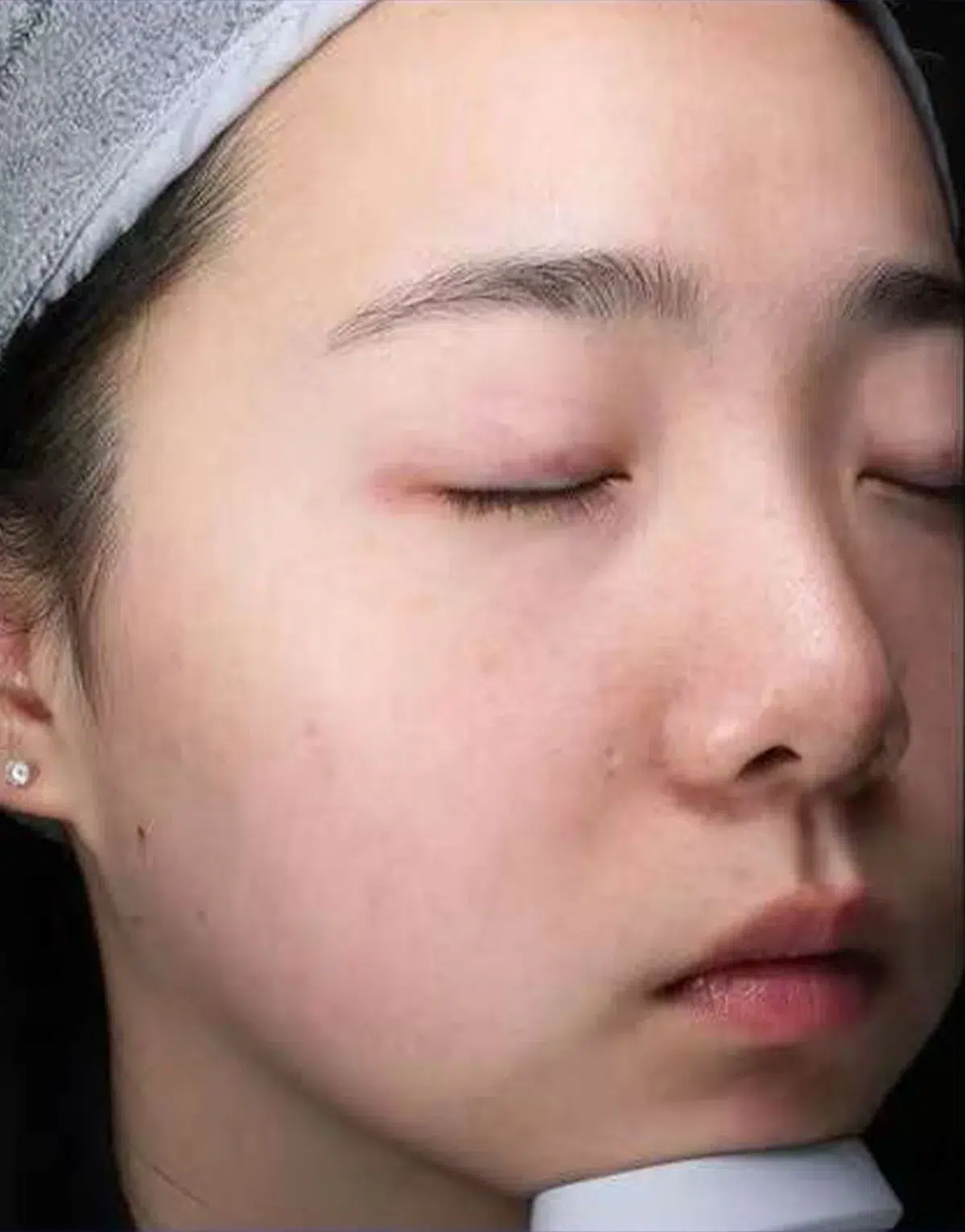 水光针 19 痤疮/粉刺/痘痘 治疗后 · 案例 02 · ID 医美